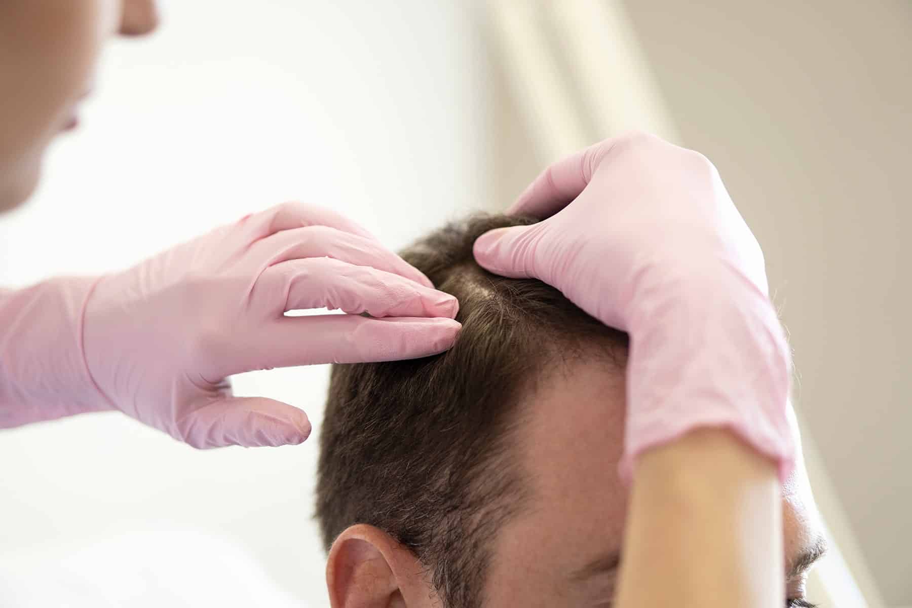 Man at Hair loss prevention appointment in Rocklin, CA