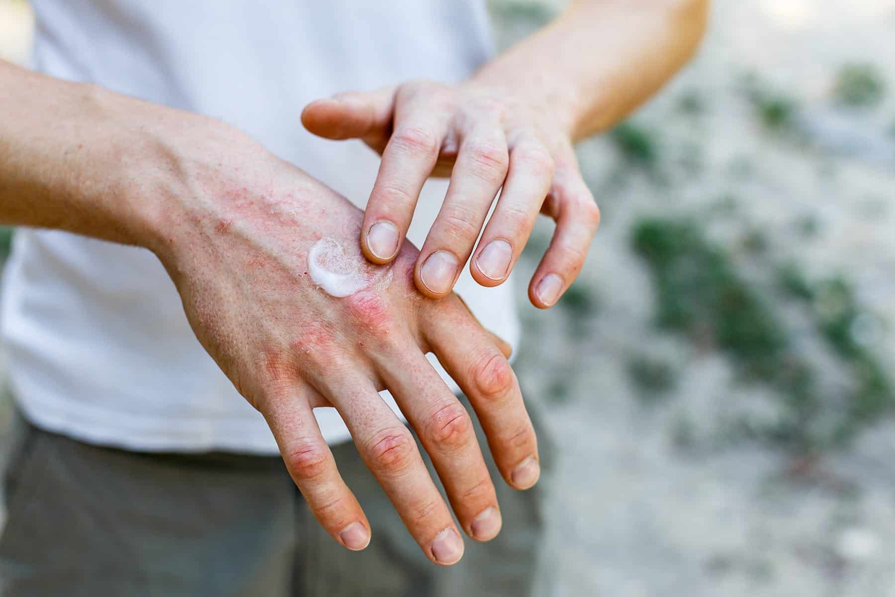 Eczema doctor in Rocklin, CA