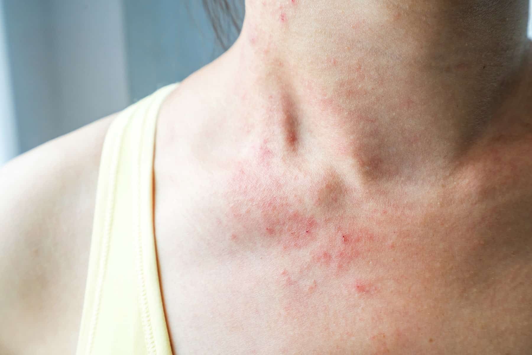 Eczema skin care in Rocklin, CA