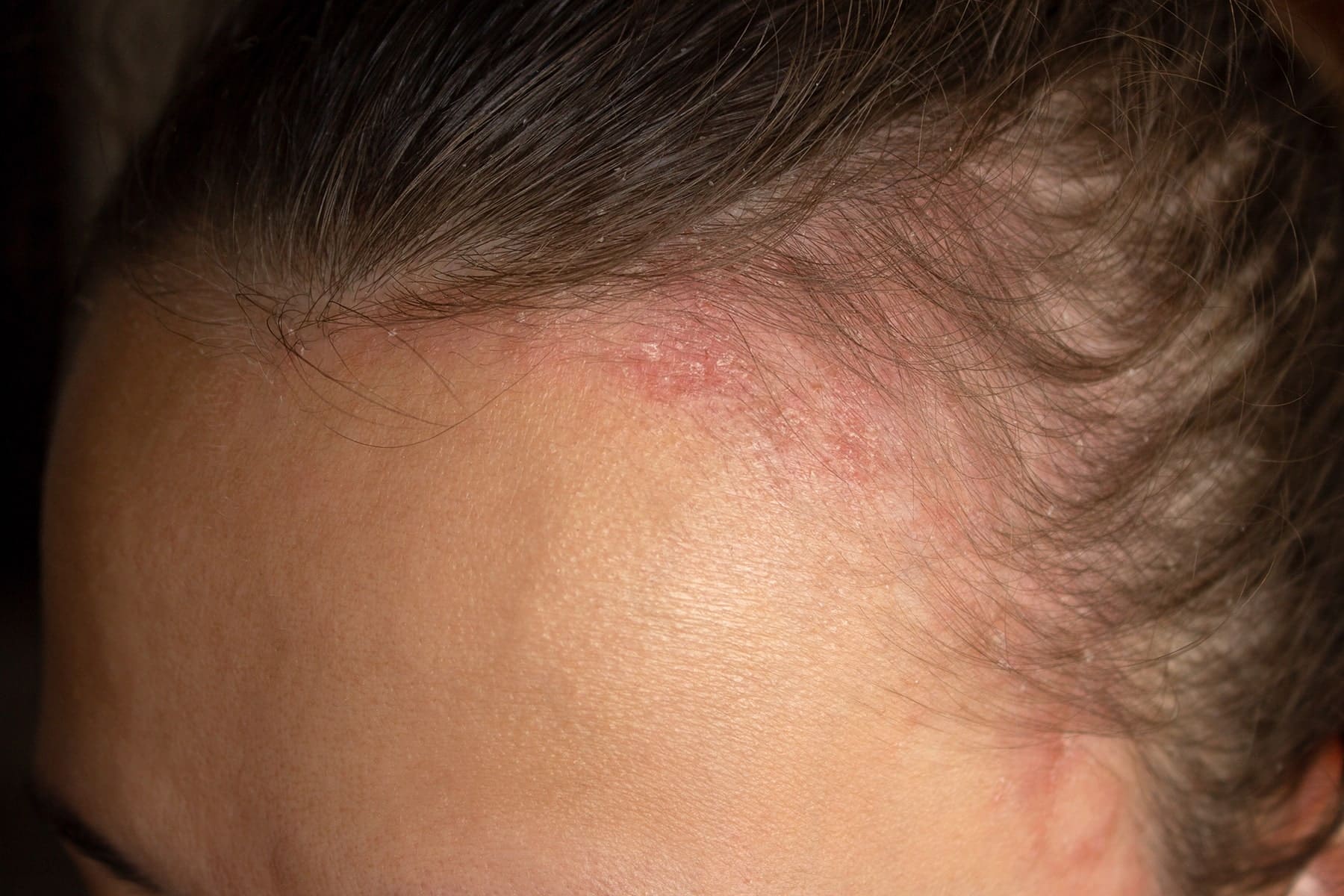 Psoriasis skin care in Rocklin, CA